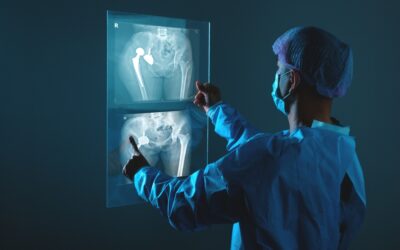 Rottura del mezzo di sintesi: nessun risarcimento senza la prova dell’errore medico